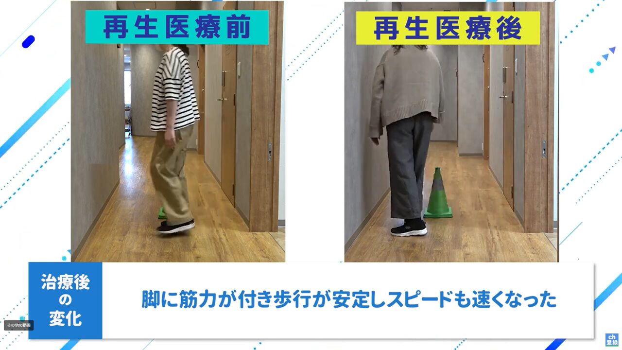 再生医療前後_脚力