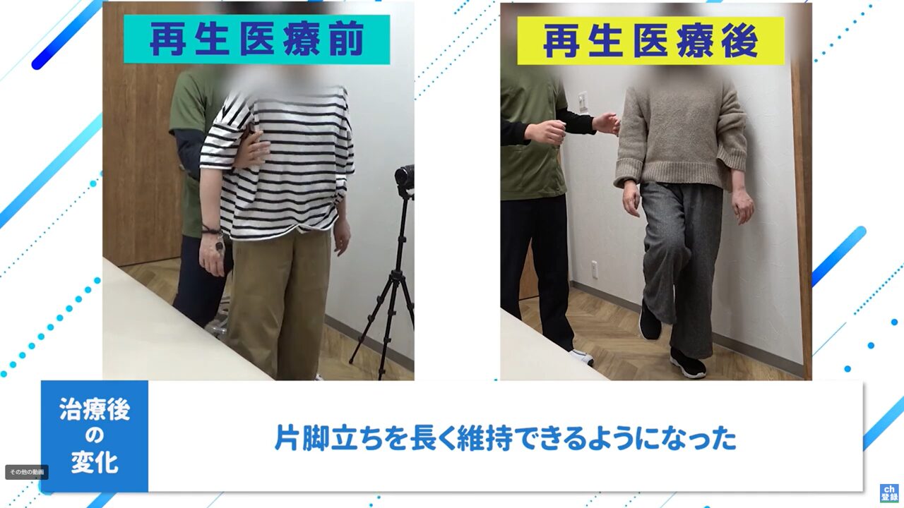 再生医療前後_片足立ち