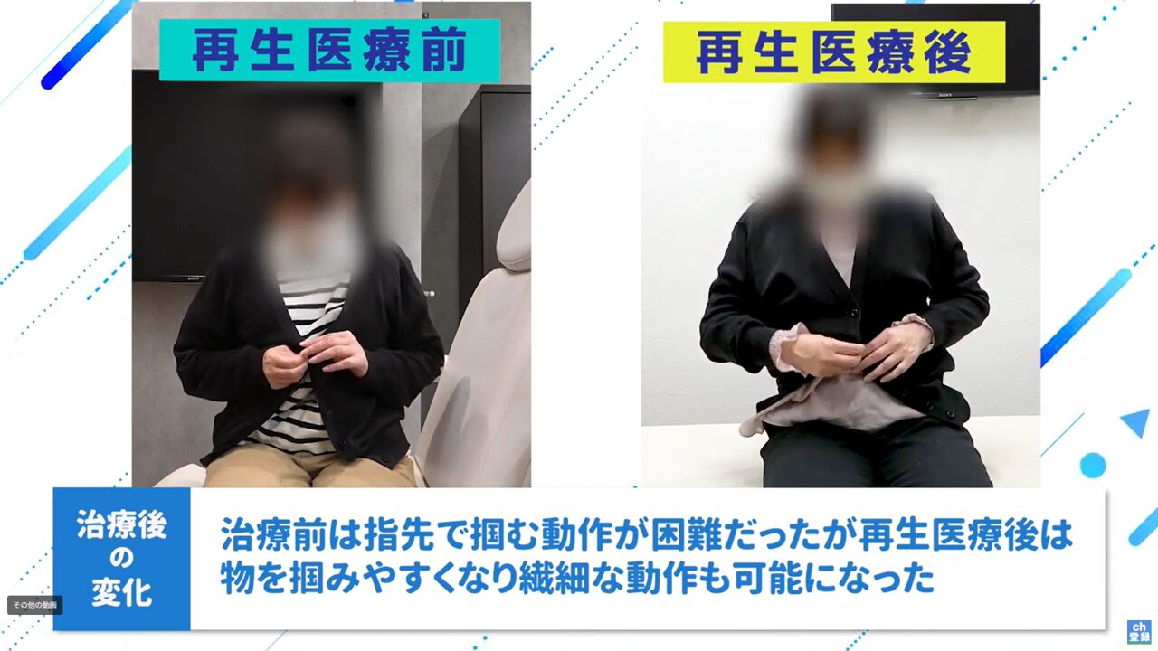 再生医療前後_指先の動作