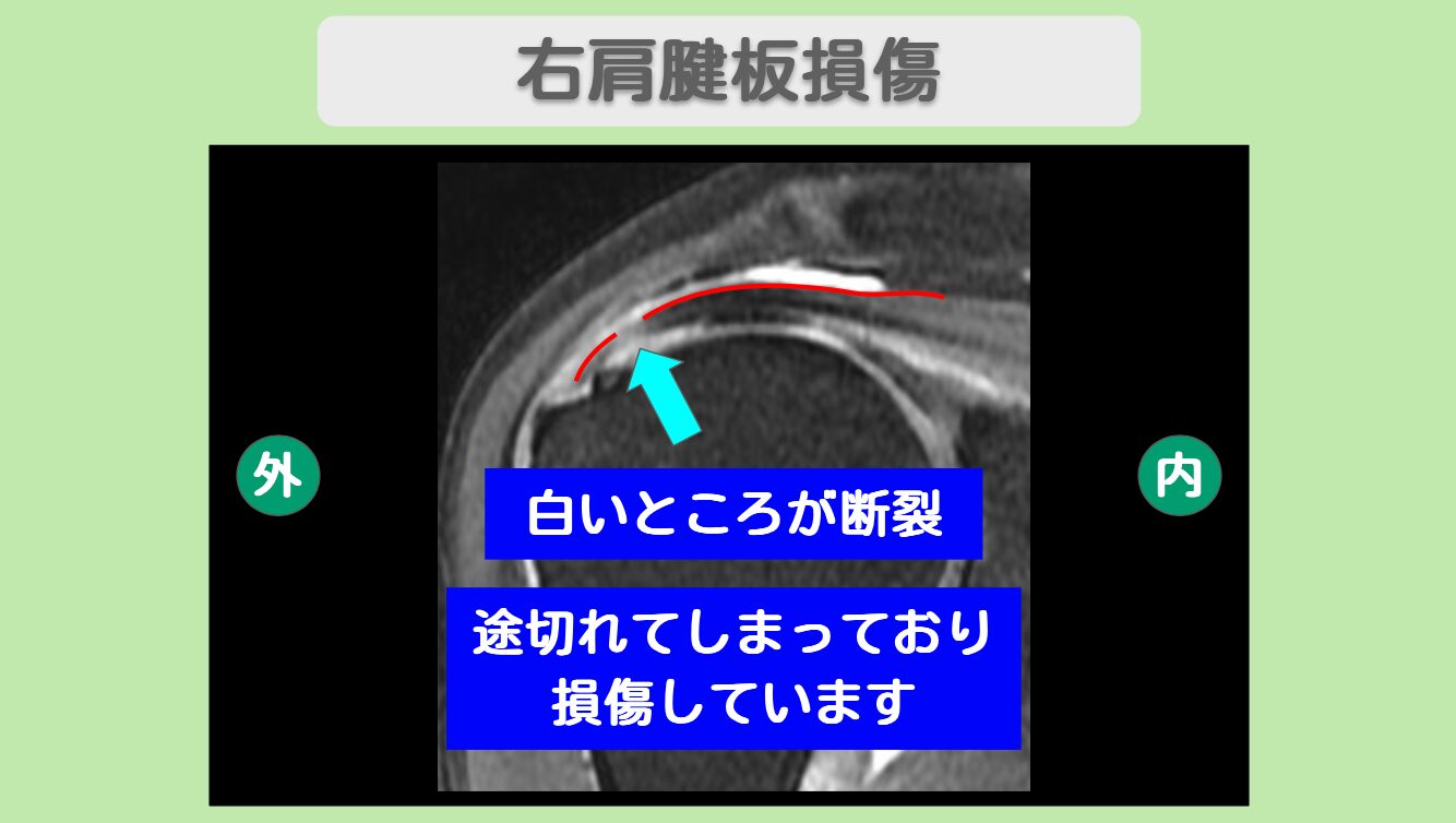 右肩腱板損傷