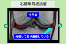 右膝半月板損傷