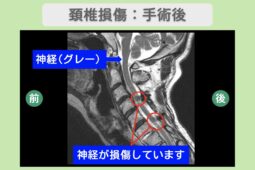 頚椎損傷：手術後