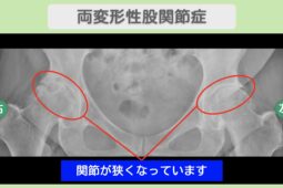 両変形性股関節症 70代女性のレントゲン所見