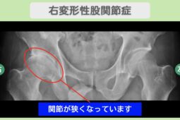 右変形性股関節症 60代男性のレントゲン所見