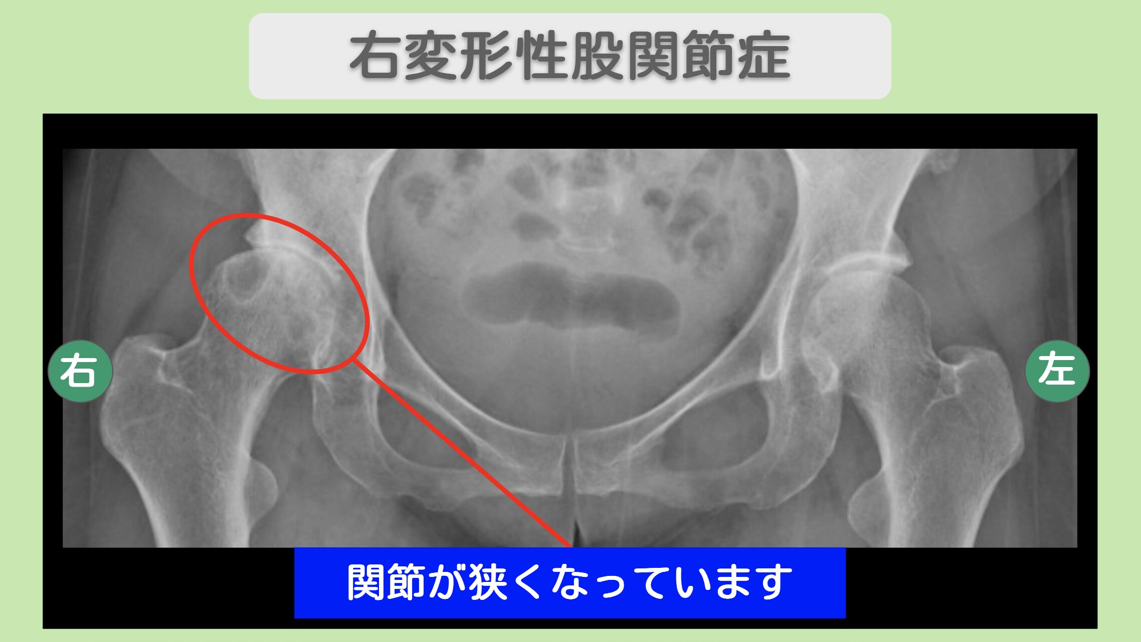 右変形性股関節症 50代女性のレントゲン所見