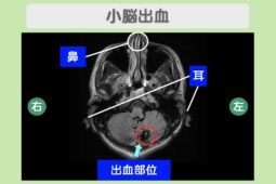 小脳出血後遺症 50代男性のMRI所見