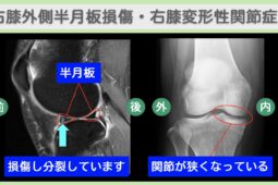 右膝外側半月板損傷・右膝変形性関節症