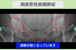 両変形性股関節症
