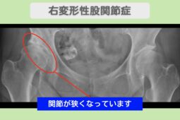 股関節(OA)の症例 東京院-1108