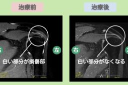 左肩腱板損傷の症例 大阪院-258