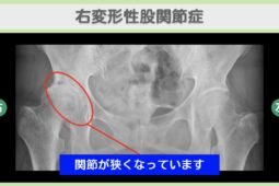 股関節(OA)の症例 大阪院-600