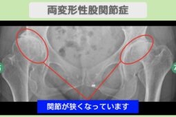 股関節(OA), 膝（OA）の症例 大阪院-685