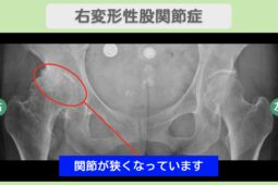 右変形性股関節症