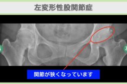 左変形性股関節症