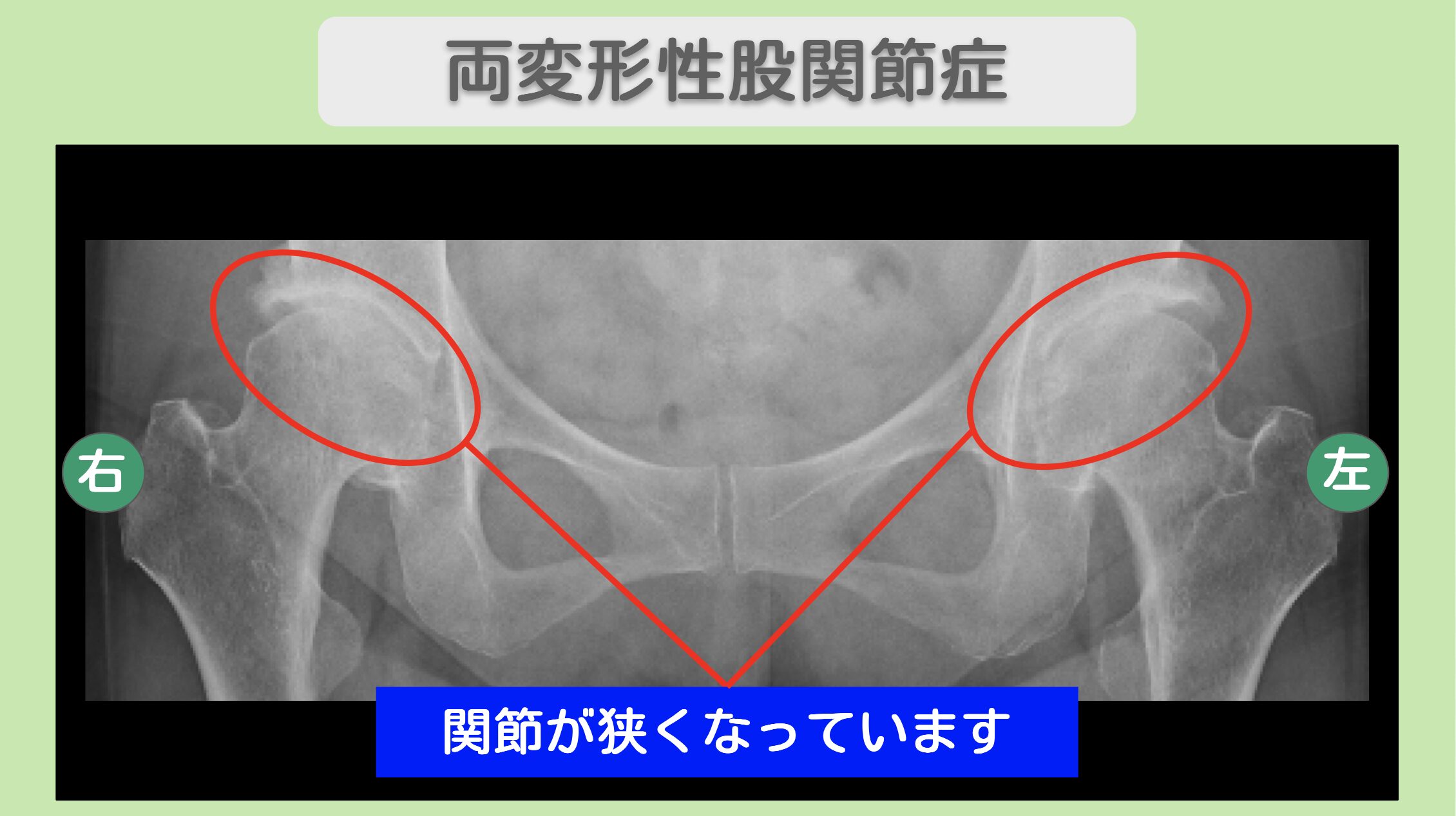 両変形性股関節症のレントゲン画像
