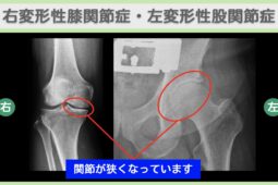 右変形性膝関節症・左変形性股関節症のレントゲン画像