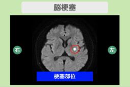 脳梗塞のMRI所見