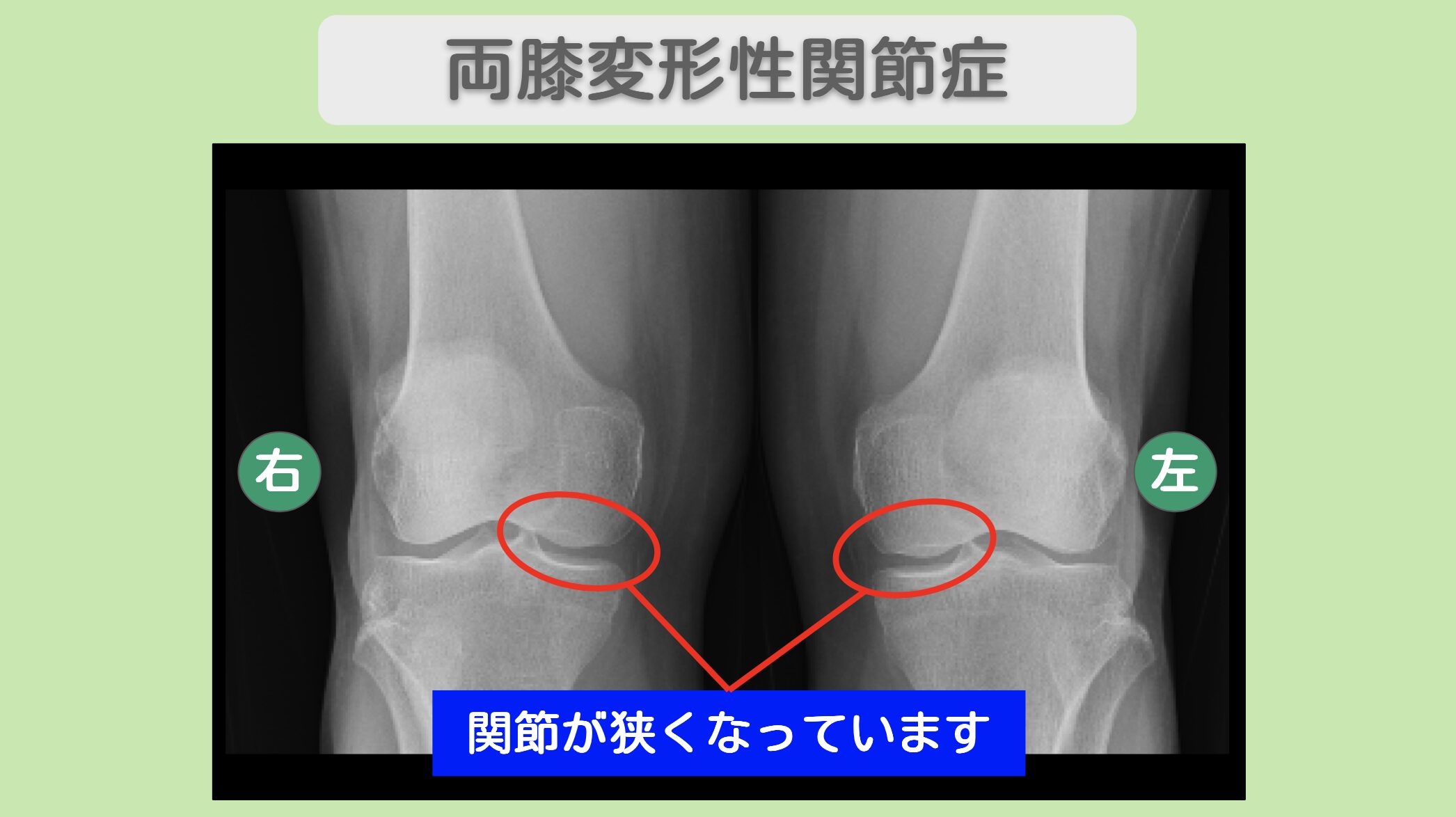 両膝変形性関節症