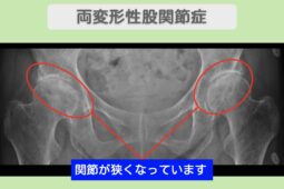 両変形性股関節症