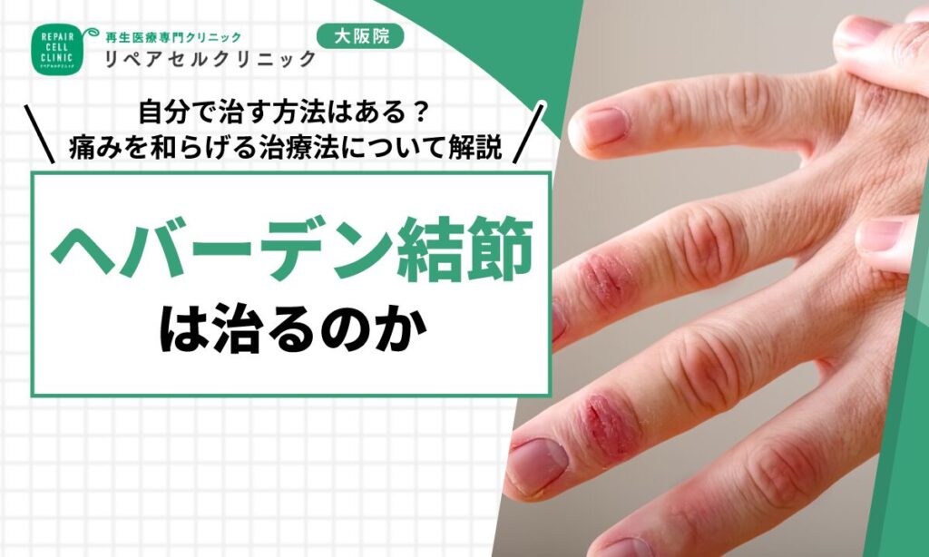 ヘバーデン結節は治るのか｜自分で治す方法はある？痛みを和らげる治療法について解説
