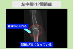 左中指PIP関節症のレントゲン所見(関節裂隙の狭小化と骨棘形成)