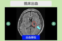 視床出血