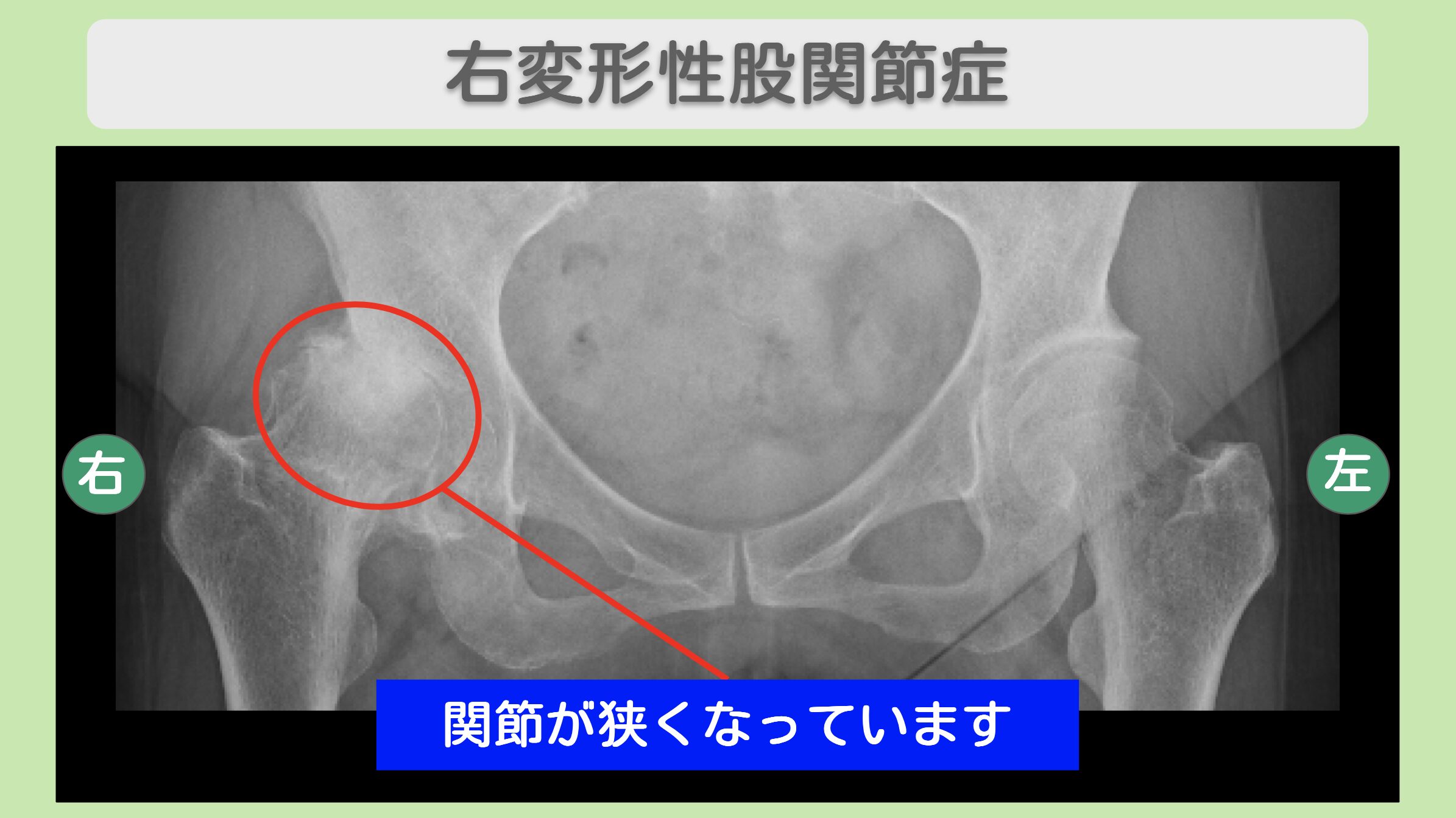 右変形性股関節症