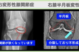 右変形性膝関節症　右膝半月板変性