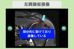 左肩腱板損傷