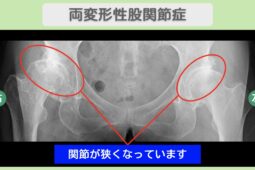 両変形性股関節症