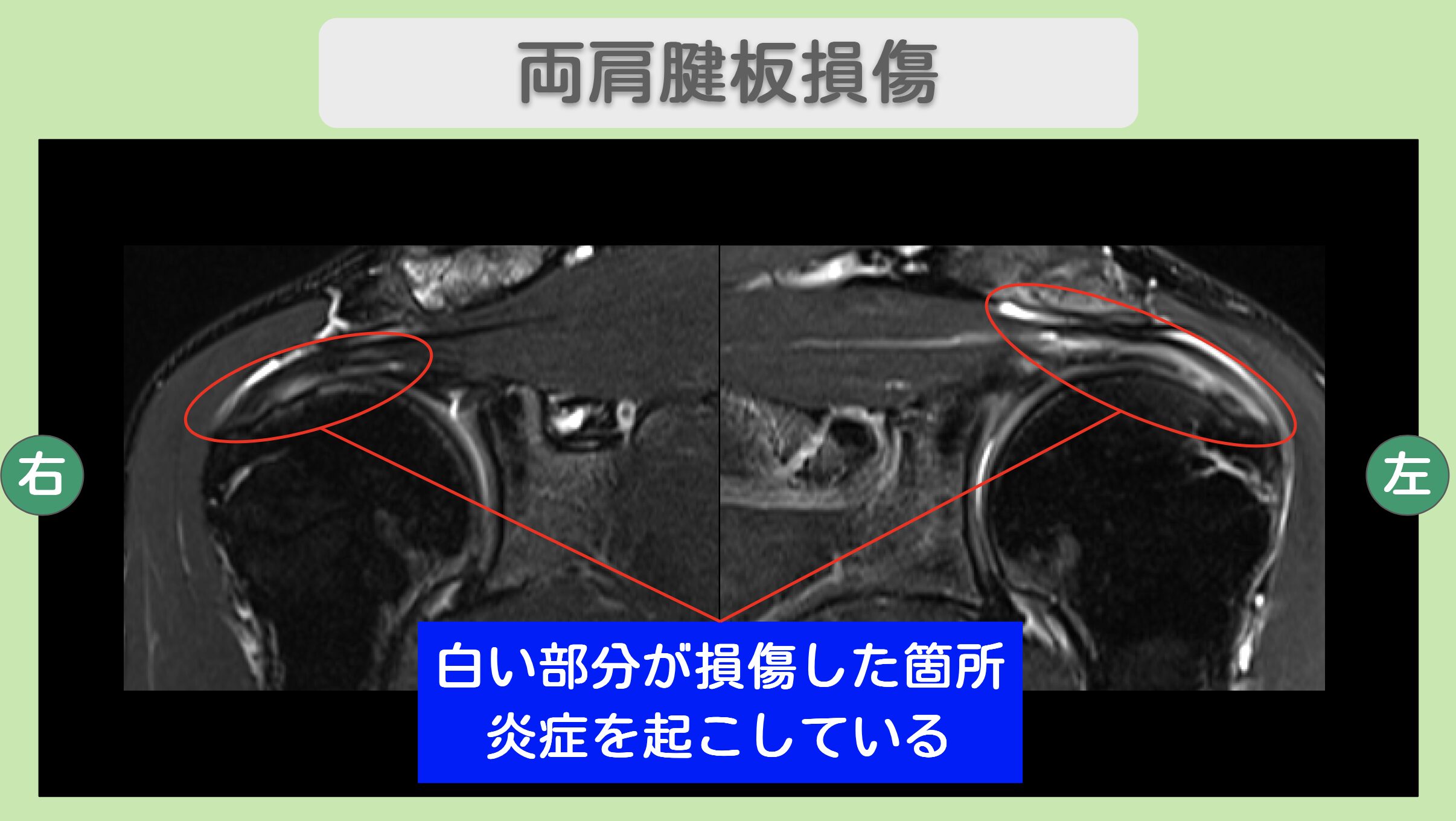 両肩腱板損傷