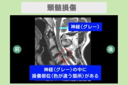 頚髄損傷