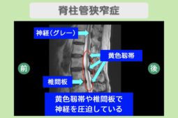 腰部脊柱管狭窄症のMRI所見