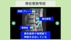 腰部脊柱管狭窄症のMRI所見