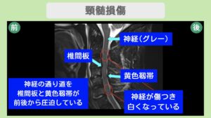 頚髄損傷のMRI所見