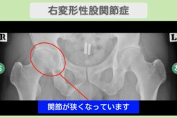 右変形性股関節症のレントゲン所見