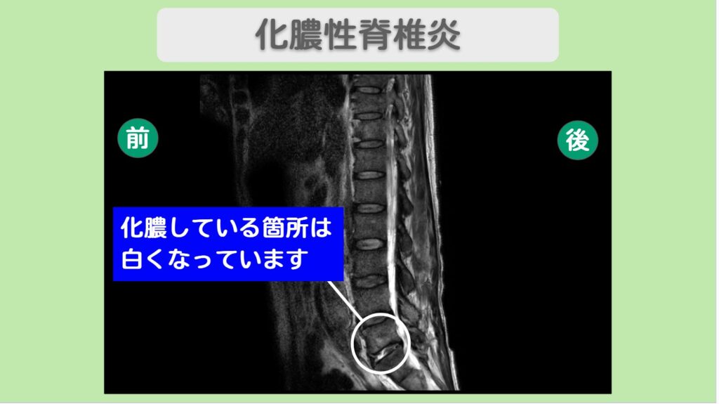 化膿性脊椎炎術後・腹部大動脈瘤術後の脊髄損傷（治療前後MRI比較）