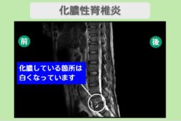 化膿性脊椎炎術後・腹部大動脈瘤術後の脊髄損傷(治療前後MRI比較)