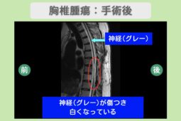 胸椎腫瘍術後の脊髄麻痺 MRI所見