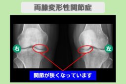 両変形性膝関節症