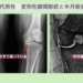 変形性膝関節症と半月板損傷の幹細胞治療