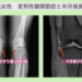 変形性膝関節症と半月板損傷の再生医療