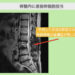 腰部脊柱管狭窄症術後の幹細胞投与