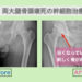 両大腿骨頭壊死レントゲン