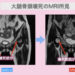 大腿骨頭壊死