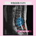 腰椎ヘルニア　幹細胞治療