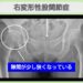 右変形性股関節症 幹細胞治療