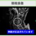 頚髄損傷 幹細胞治療