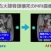 右大腿骨頭壊死症　幹細胞治療