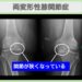 両変形性膝関節症　幹細胞治療